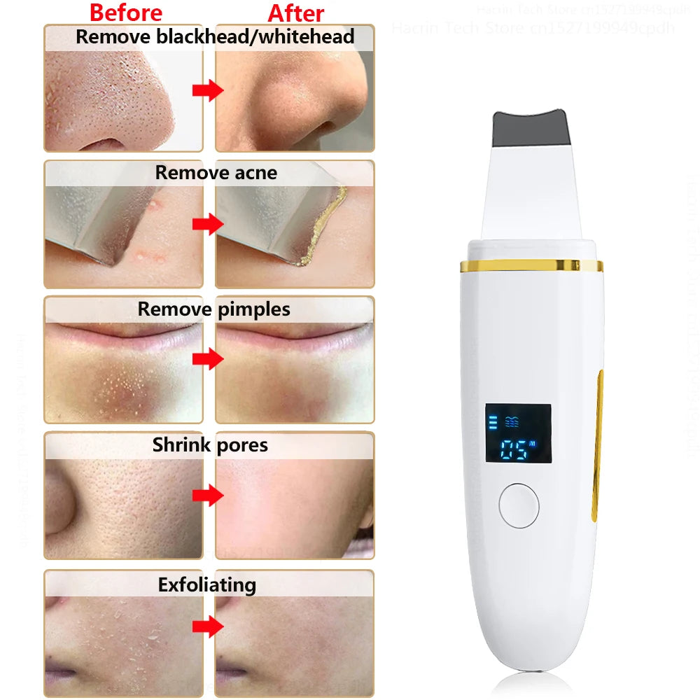 Z9 Ultrasonic Acne & Blackhead Remover