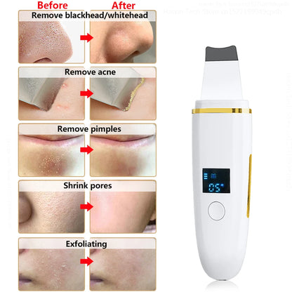 Z9 Ultrasonic Acne & Blackhead Remover